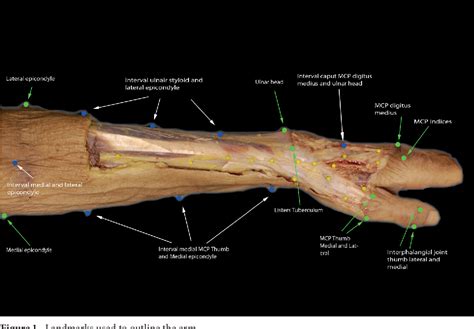 Figure 1 From The Anatomical Relationship Of The Superficial Radial