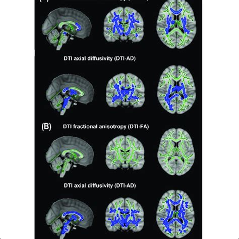 Diffusion Tensor Imaging Derived Measures Of White Matter Integrity