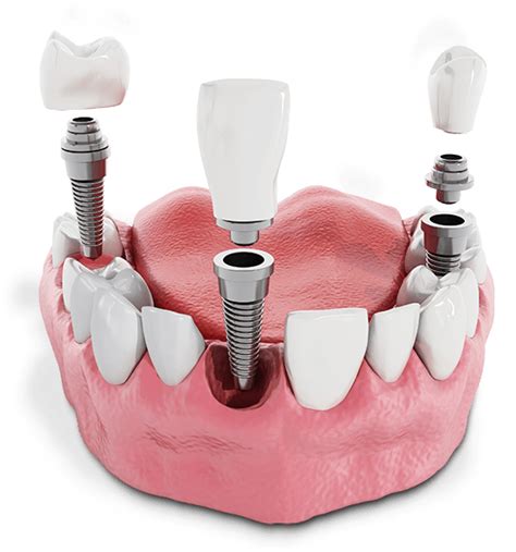 Stabili Teeth™ Gibsonia Pa Smile Dental Center