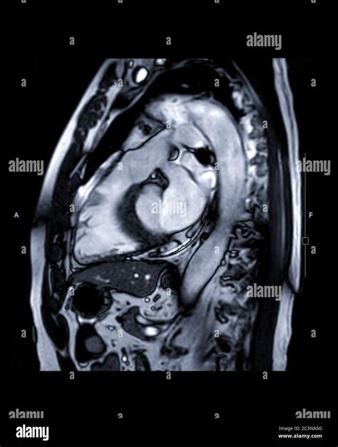 Mri Heart Or Cardiac Mri Magnetic Resonance Imaging Of Heart Lvot