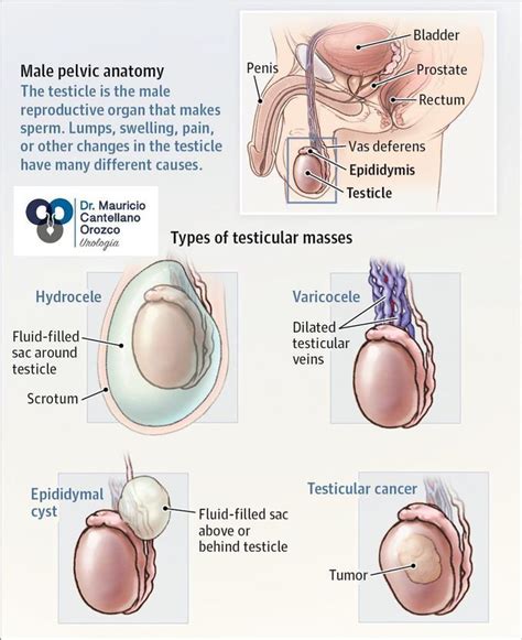 Different Type Of Testicular Masses Medizzy