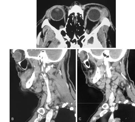 Lacrimal Gland Lymphoma Clinical Tree