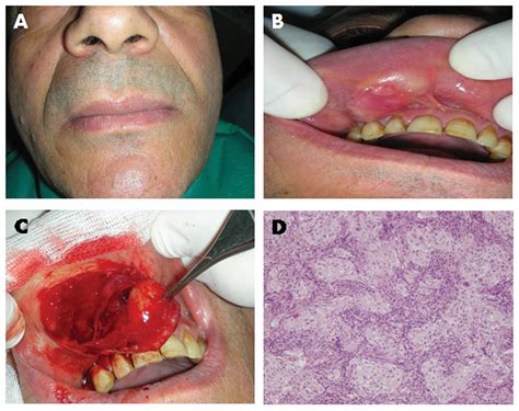 Intraoral Lymphoepithelial Carcinoma Of The Minor Salivary Glands In Vivo