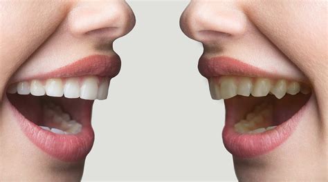 There are multiple ways this procedure can be performed. How to fix crooked teeth - Dental at Joondalup