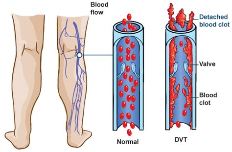 Blood Clots Prevention Of Dvtpe — Chelsea And Westminster Hospital