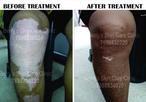 All You Need To Know About Vitiligo Treatment In Ahmedabad