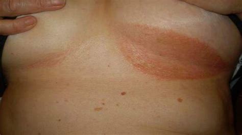 Brown spots associated with dryness may cause to develop some concern. Pin on Moisture Associated Dermatitis