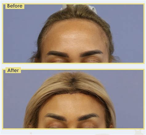 Gallery Forehead Reduction