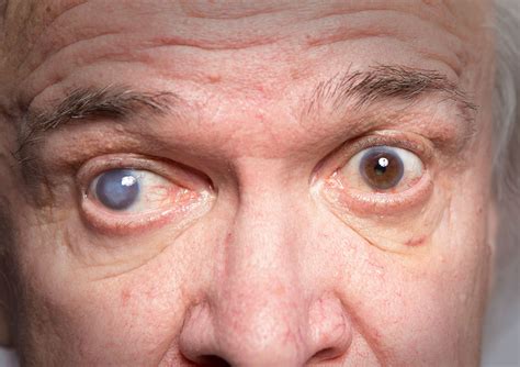 Glaucoma is a progressive vision condition that can lead to permanent blindness. ¿Qué es el glaucoma?