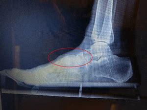 A bone spur may be caused by degenerative arthritis or tendonitis. Bone Spur On Top Of Foot: Causes, Symptoms & Best Treatment!