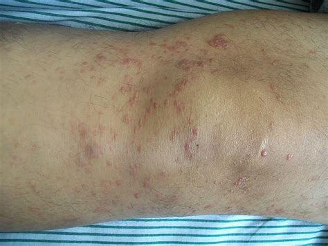 Pityriasis Rosea Differential Diagnosis Wikidoc