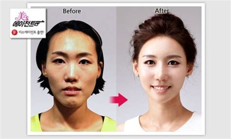 Young Koreans Before And After Extreme Plastic Surgery 50 Pictures Memolition