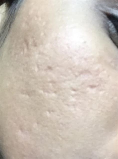Moderate Severe Acne Scars Treatment Post 2 Rounds Of Fraxel 3 Rounds