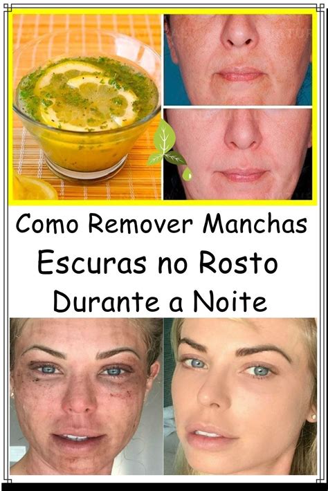 Como Remover Manchas Escuras No Rosto Durante A Noite