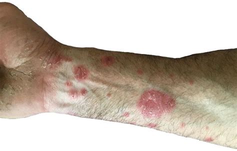 Psoriatic Lesions On The Inner Surface Of The Forearm Download
