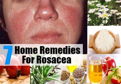 7 Home Remedies For Rosacea Home Remedies For Rosacea Rosacea