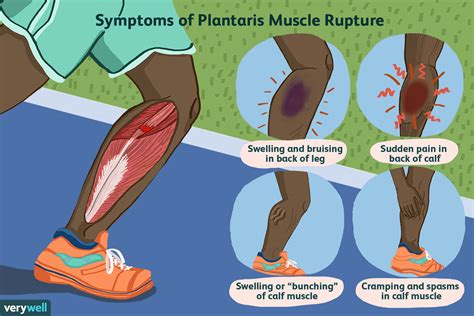 Tendonitis is the inflammation of a tendon. Plantaris Muscle Tears and Calf Pain