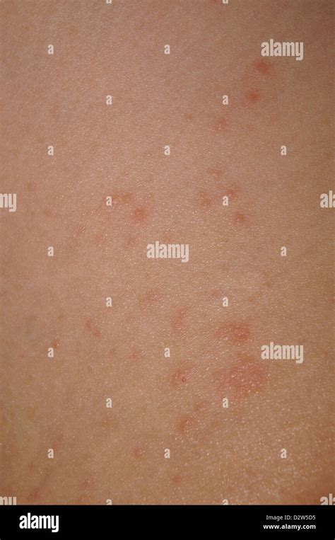 Skin Rash Hi Res Stock Photography And Images Alamy