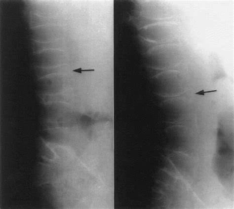 High Incidence Of Significant Bone Loss In Patients With Severe