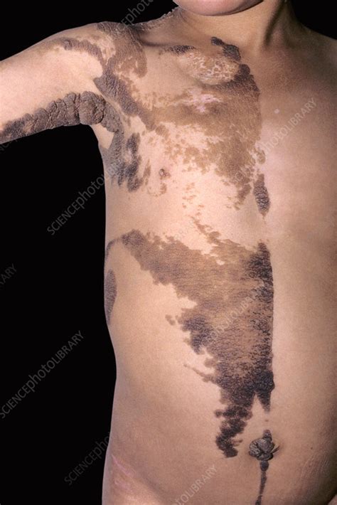 Epidermal Nevus Syndrome Stock Image C0515531 Science Photo Library