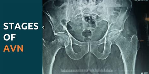 Stages Of AVN Or Avascular Necrosis