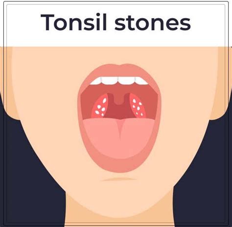 Tonsil Stones Guide Dentist Ahmed Official Website
