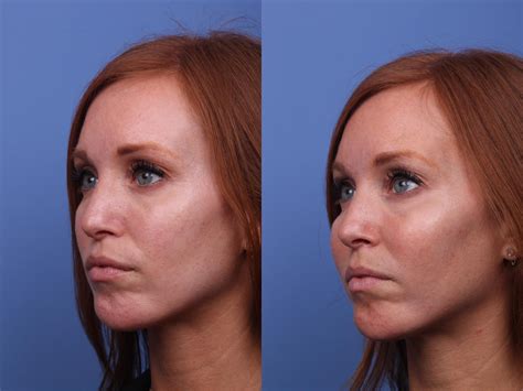 Cheek Implant Before And After Pictures Case 317 Scottsdale And Phoenix Az Hobgood Facial