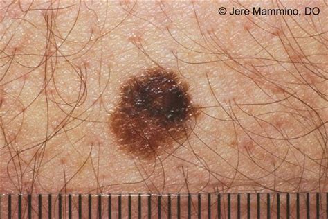 Atypical Moles American Osteopathic College Of Dermatology Aocd