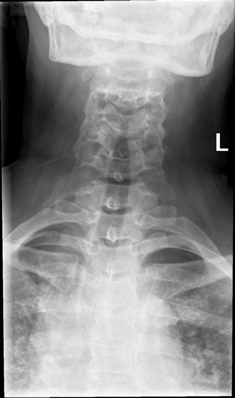 Lateral Cervical X Ray