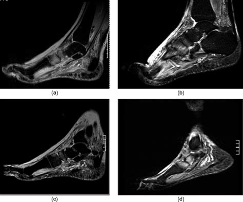 A Baseline Diagnostic Mri Of Active Stage Charcot Foot Grade 0 Four