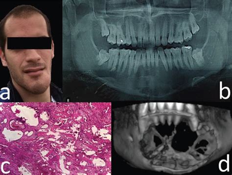 Aneurysmal Bone Cyst Of The Mandible A Case Report And Review Of My