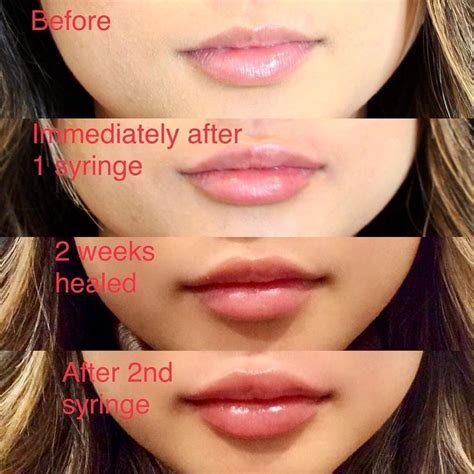 Pin By Puerisha On Face Lip Fillers Fuller Lips Naturally Botox Lips