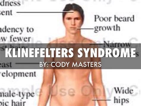 Klinefelter S Syndrome Causes Symptoms Diagnosis Treatment The Best Porn Website
