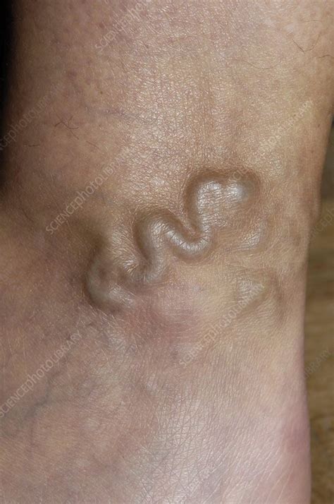 Varicose Vein In The Leg Stock Image C0051862 Science Photo Library