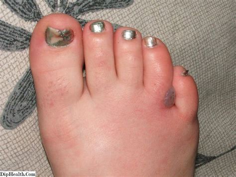 You might have heard it called a superbug. Galerie von Hautkochbildern und anderen Infektionen ...