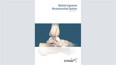 Arthrex Deltoid Ligament Reconstruction