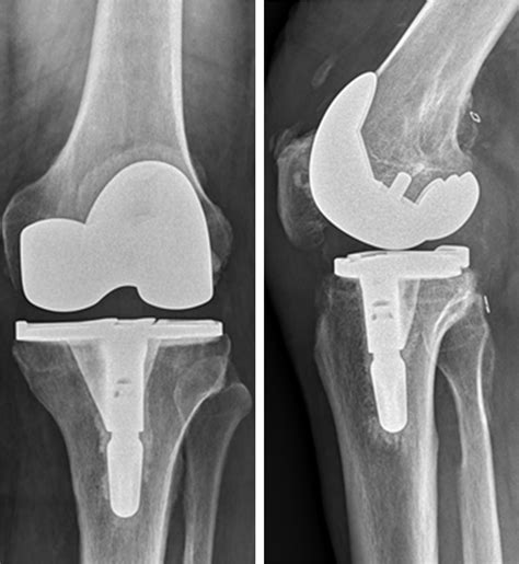 Reduced Aseptic Loosening With Fully Cemented Short Stemmed Tibial