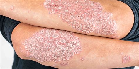 Plaque Psoriasis Clinical Trial Moderate To Severe 4 Months