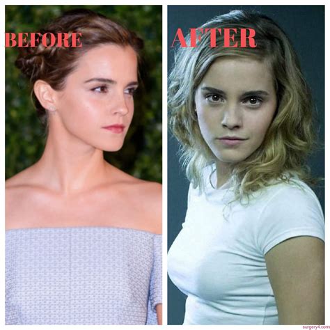 emma watson plastic surgery boob job photos [before and after] surgery4
