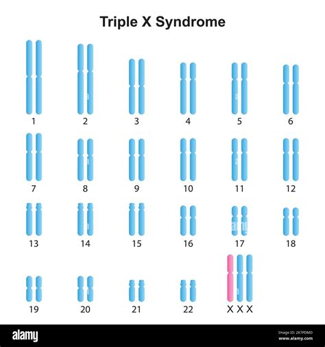 Scientific Designing Of Triple X Syndrome Trisomy X Karyotype Colorful Symbols Vector