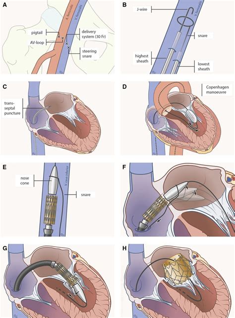 First In Human Case Of Transfemoral Cardiaq Mitral Valve Implantation