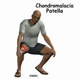 Patellofemoral Chondromalacia Treatment