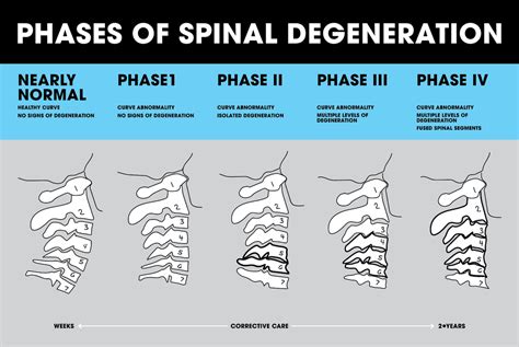 Phases Of Spinal Degeneration Mind Tweak
