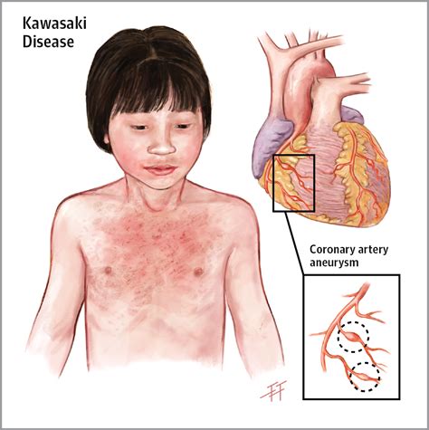Summarizing What Has Been Learned About Kawasaki Disease Cardiology