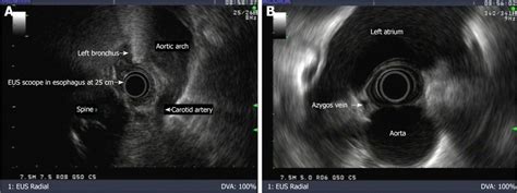 Identification Of Landmarks By Endoscopic Ultrasound A Endoscopic