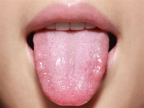 The cigarettes community on reddit. Sleep Apnea Can Be Improved By Losing Fat In The Tongue ...