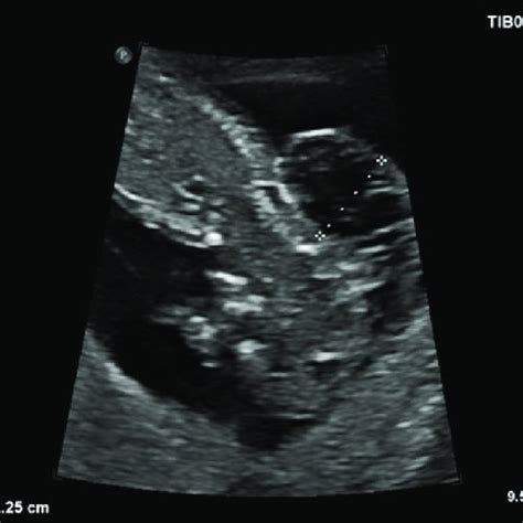 Antenatal Ultrasound Scan View Showing The Foetal Abdomen And Revealed