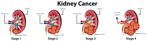 What causes kidney cancer (renal cell cancer)? Diagram showing different stages of kidney cancer ...