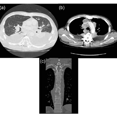Chest Ct Scan Revealed Multiple Tumors In Bilateral Lung A Pleural