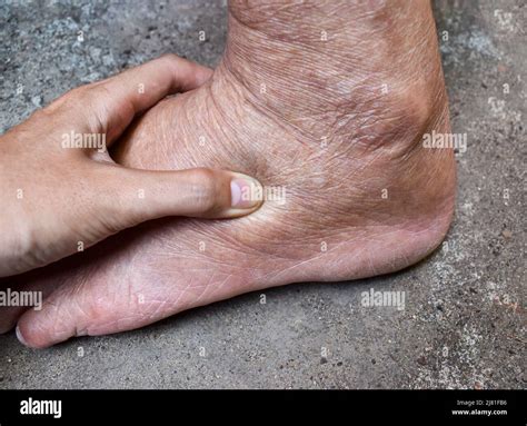 Pitting Edema Of Lower Limb Swollen Leg Of Asian Old Man Stock Photo